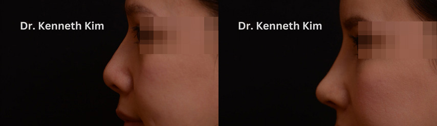 Asian nose surgery results for female patient. Shape of the bridge has been smoothed for the nose to come to a balanced tip with decreased nostril visibility.