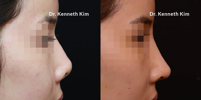 Awake rhinoplasty results for female Asian patient. Note the smoother contour of the bridge with the nose tip lowered slightly, reducing visibility of the nostrils when facing the patient.