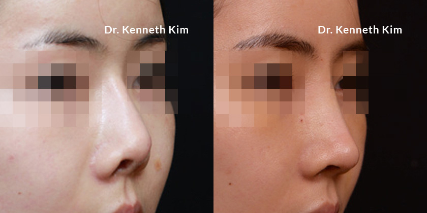 Patient wanted to refine nostril shape, address overall nose shape, and add a feminine contour to the nose tip. Each element was accomplished, resulting in a nose that looks natural, blending with and enhancing the patient's natural facial features.