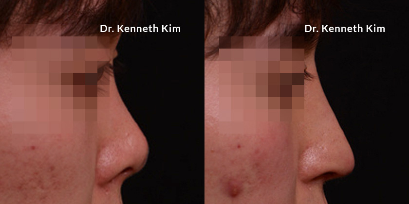 Before-and-after photo for male patient following awake rhinoplasty. The nose tip was brought down slightly for a more defined profile and smoother nasal bridge.