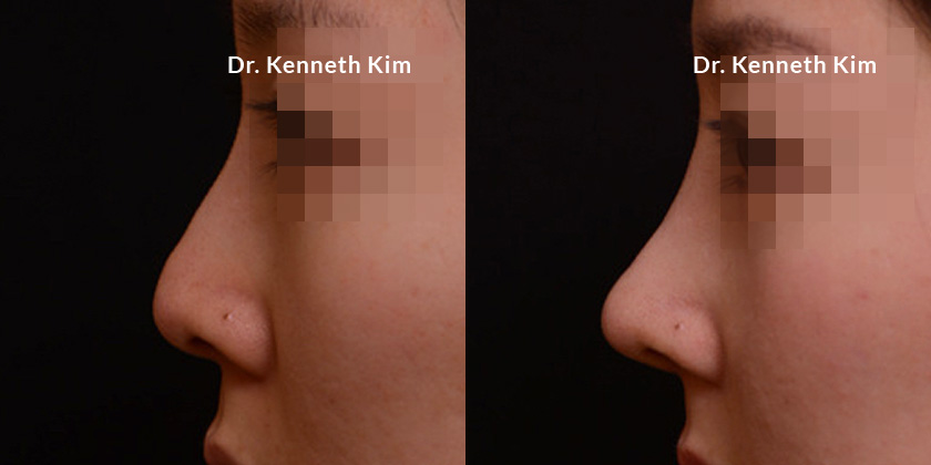 Female patient results following awake rhinoplasty, demonstrating the refined slope to her nose. A slight prominence to the nose tip adds to the feminine aesthetic.