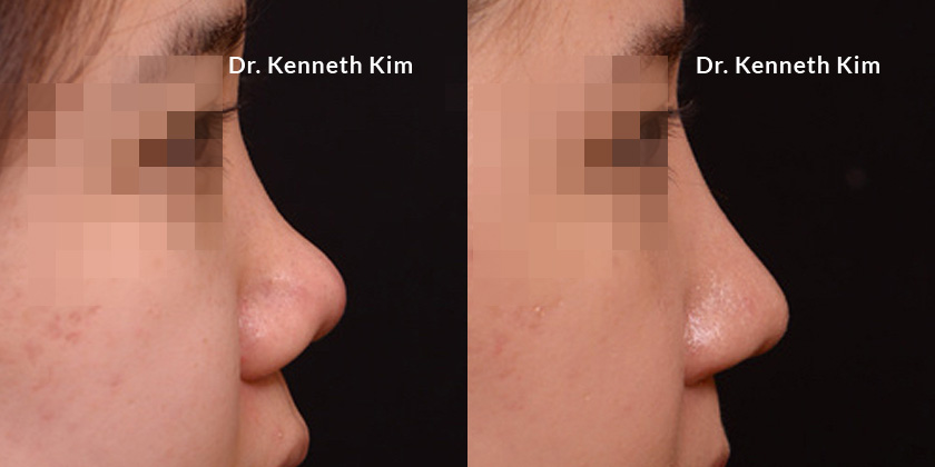 Patient results following awake nose surgery. Precise structure changes allowed for reduction in nostril size, smoothing out the slope of the bridge, and maintaining position of the nasal tip.