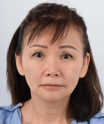 Facelift Before & After Patient #5421