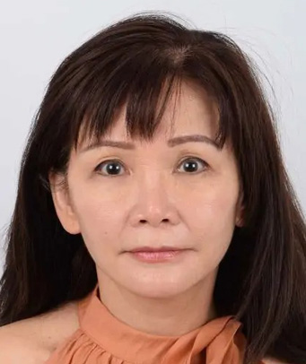 Facelift Before & After Patient #5421