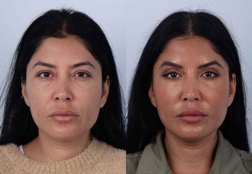A sub-brow lift, mini mid-facelift, and lateral canthoplasty procedures were performed on a patient in her late 30s. The sub-brow lift helped lift the eyes by removing the thick, heavy skin and fat just above the eyelids. The mini facelift was non-invasive and targeted the midface. It is often for those with mild to moderate signs of aging. The lateral canthoplasty reshaped the outer corners of the eyes for brighter and larger eyes. The subtle, delicate changes from these procedures helped the patient achieve a very natural and youthful appearance.