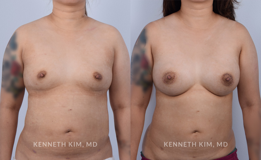 Breast Augmentation Patient 15 - 1