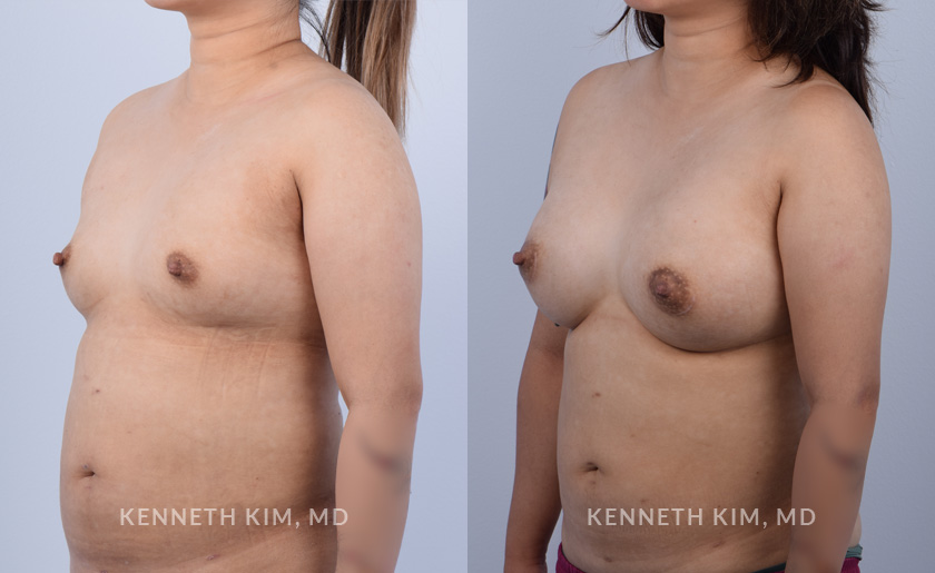 Breast Augmentation Patient 15 - 2