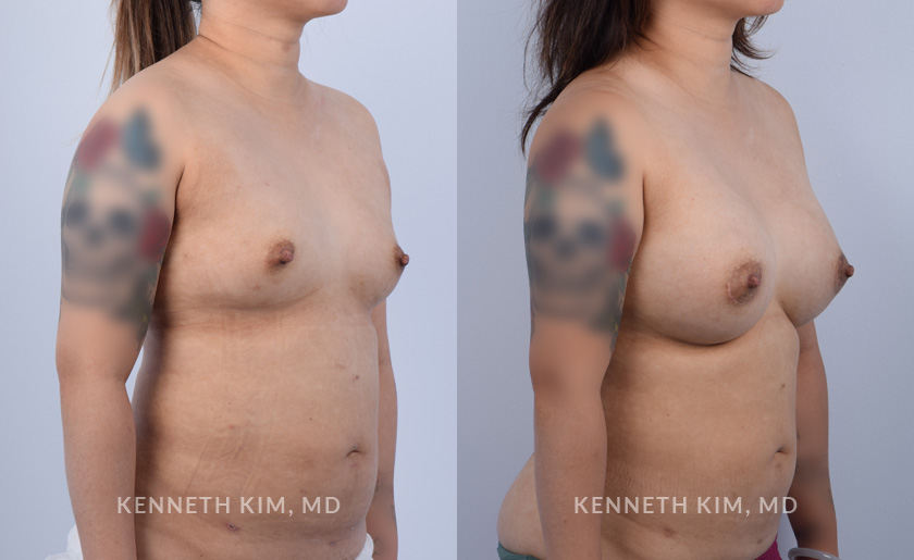 Breast Augmentation Patient 15 - 4