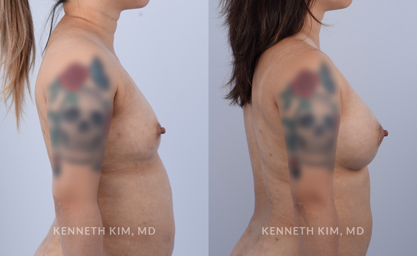 Breast Augmentation Patient 15 - 5