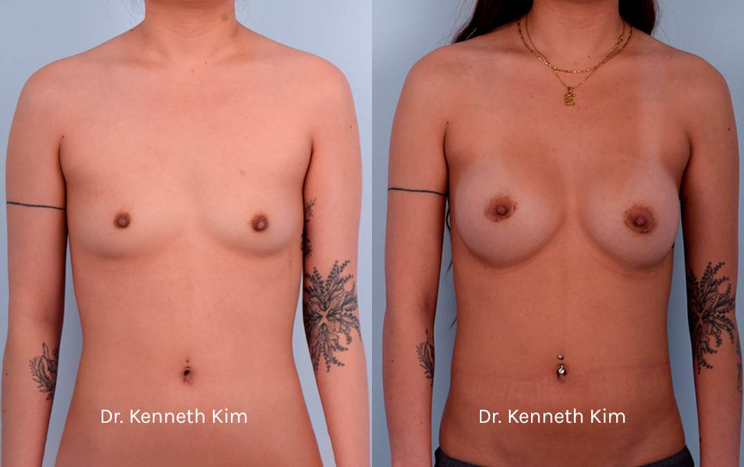 Breast Augmentation Patient-13