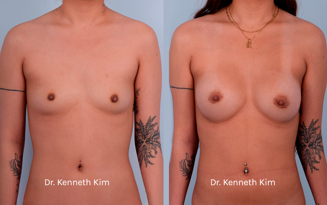 Breast Augmentation Patient-13