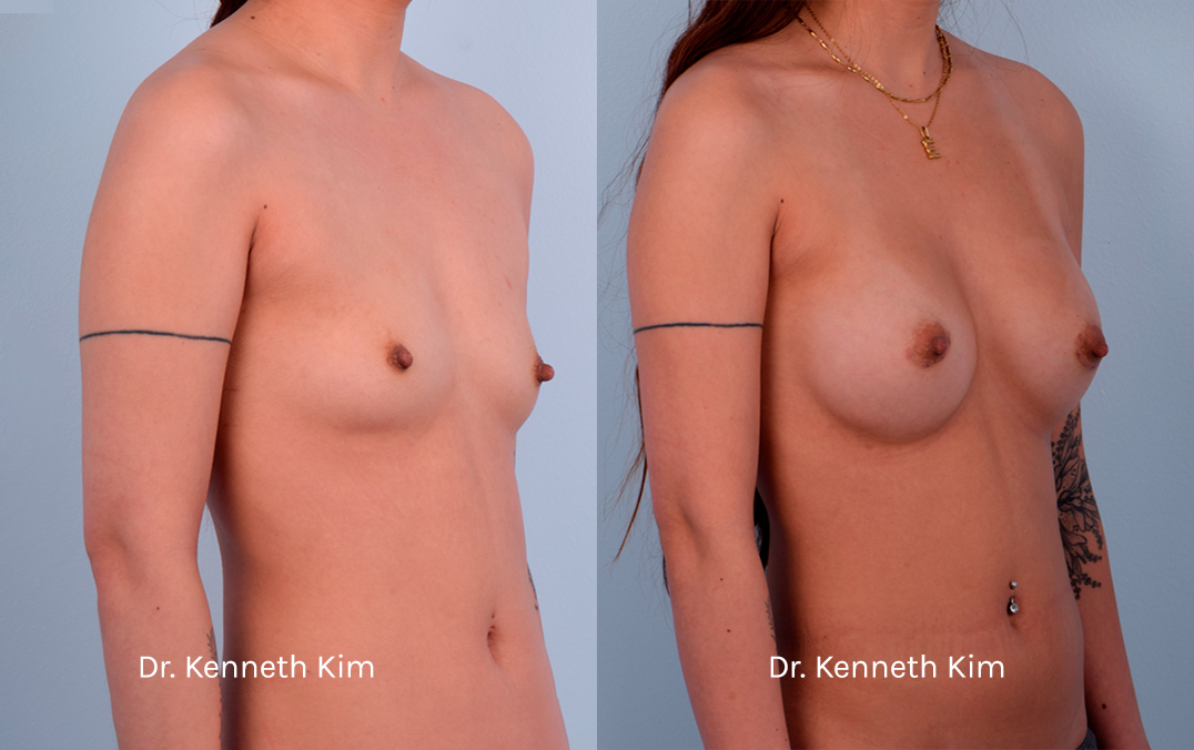 Breast Augmentation Patient-13