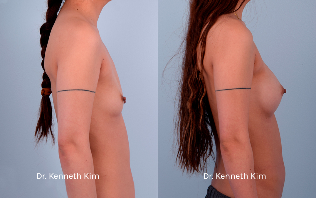 Breast Augmentation Patient-13