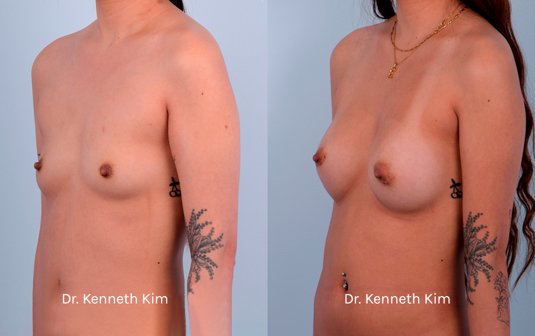 Breast Augmentation Patient-13