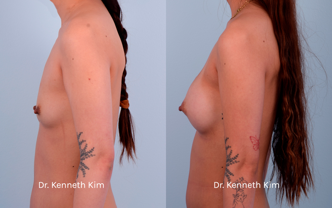 Breast Augmentation Patient-13