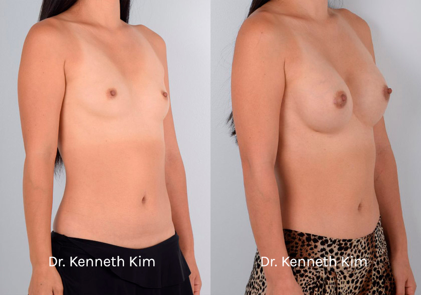 Breast-Augmentation-Patient-13A