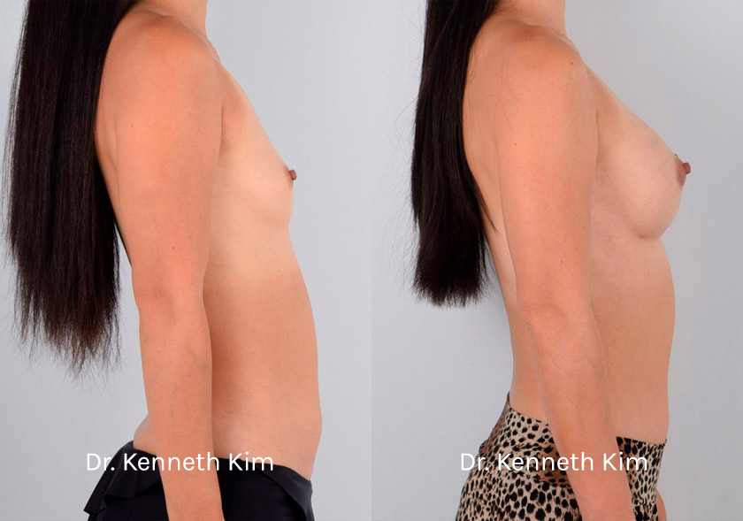 Breast-Augmentation-Patient-13B