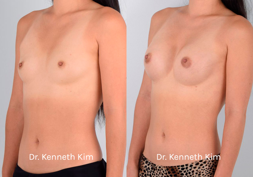 Breast-Augmentation-Patient-13C
