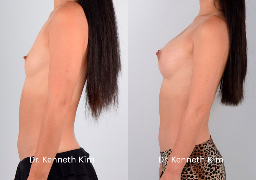 Breast-Augmentation-Patient-13D