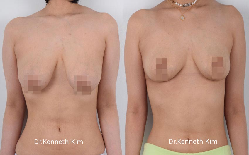 Breast Reduction and Lift1