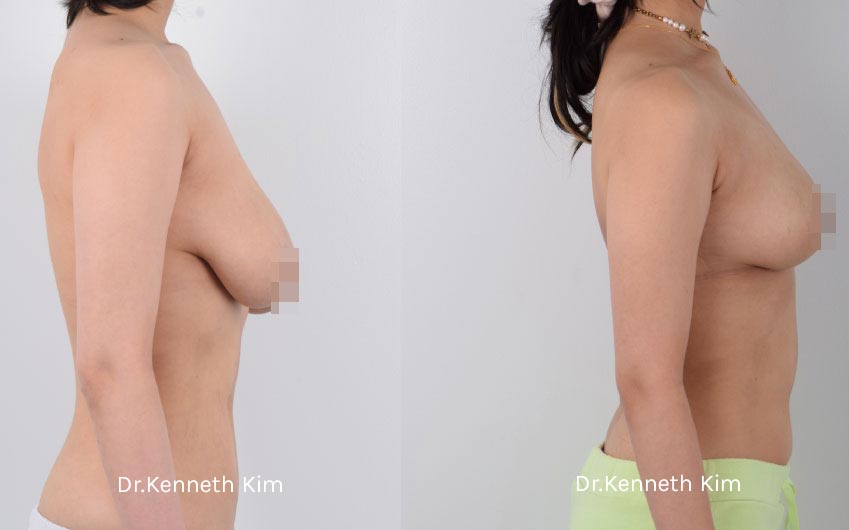 Breast Reduction and Lift 2