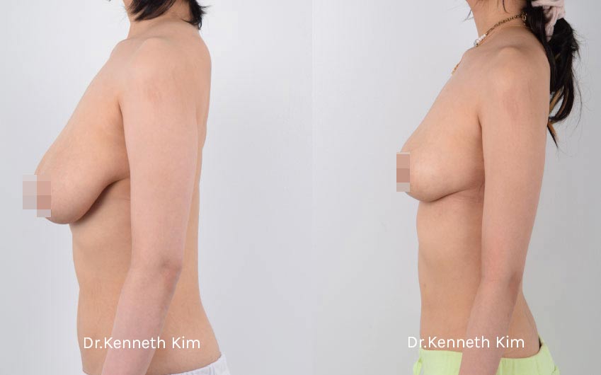 Breast Reduction and Lift 3