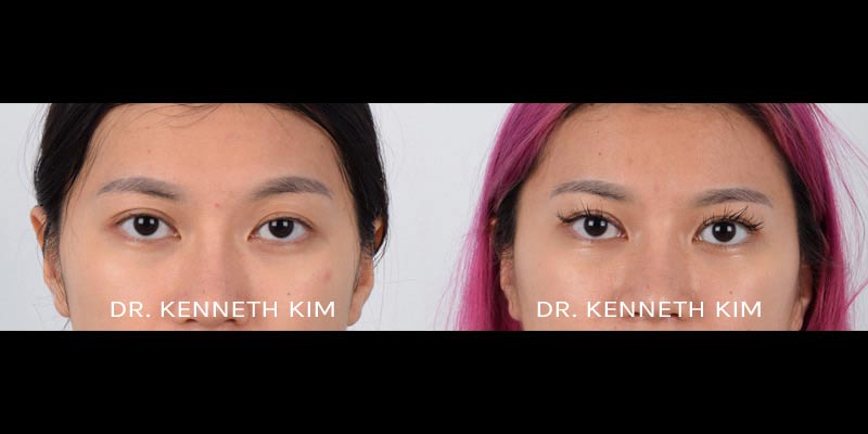 Eyelid-Surgery-Patient-