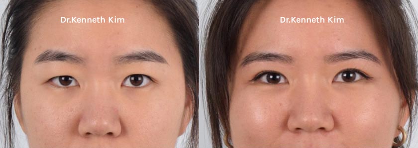 Brow / Forehead Lift