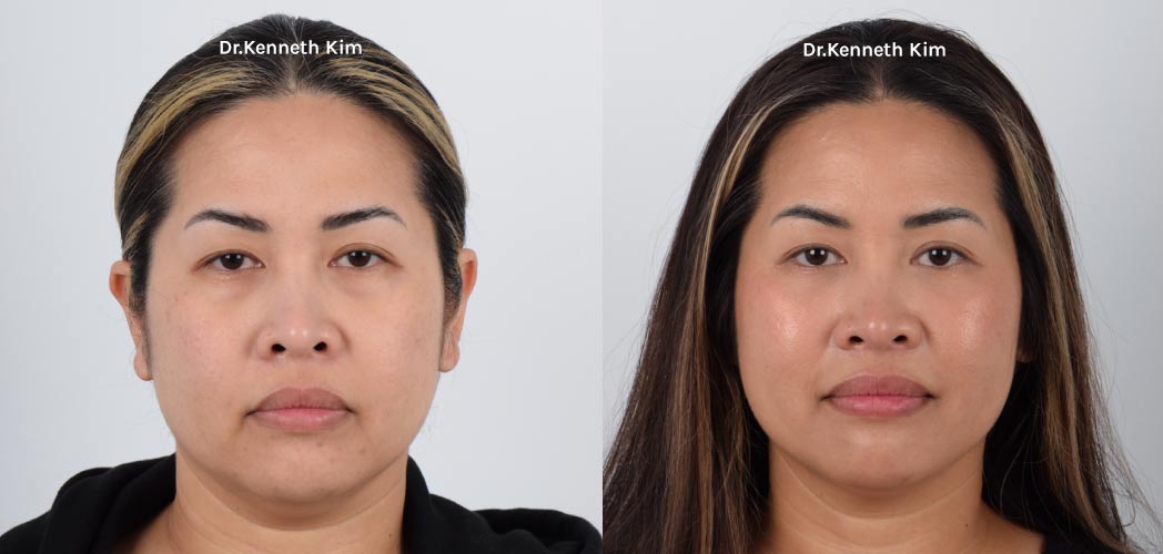 Lower-Blepharoplasty