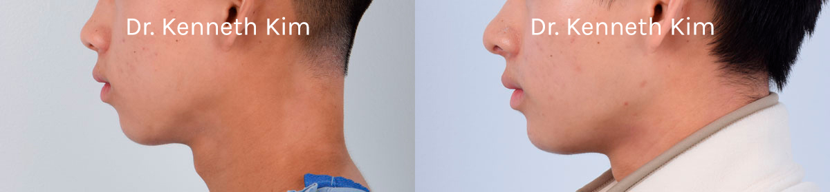 Chin Augmentation Patient-01