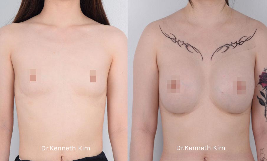 Breast Augmentation Patient-14