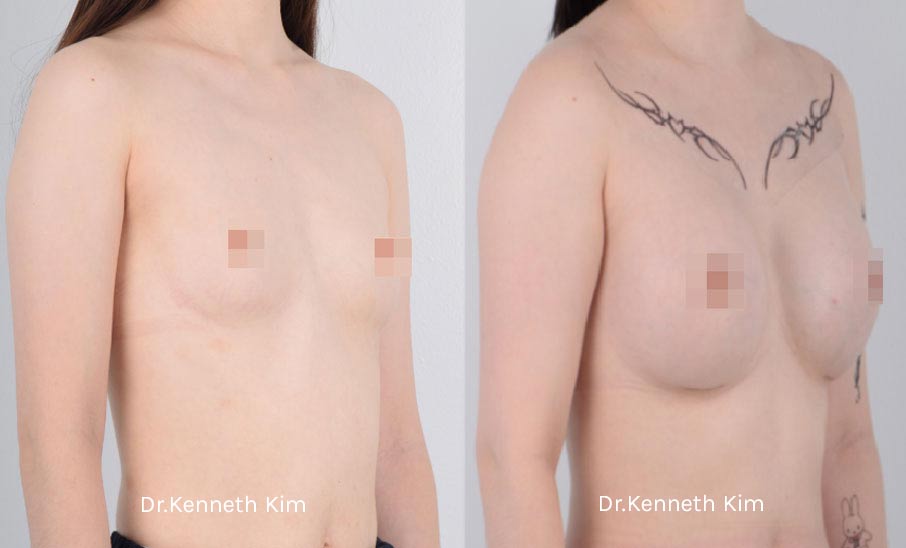 Breast Augmentation Patient-14 2