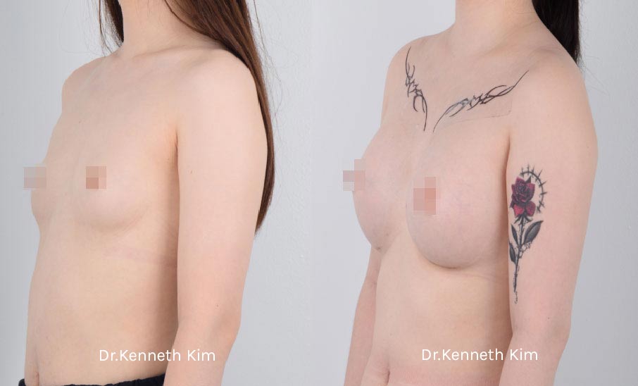 Breast Augmentation Patient-14 3