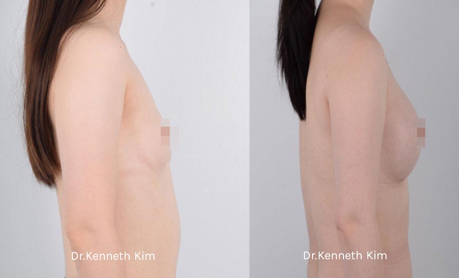 Breast Augmentation Patient-14 4