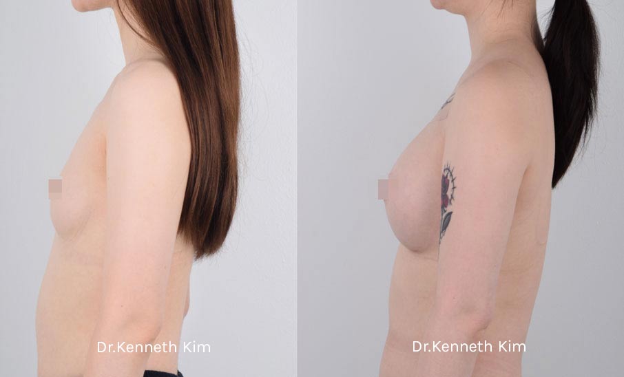 Breast Augmentation Patient-14 5