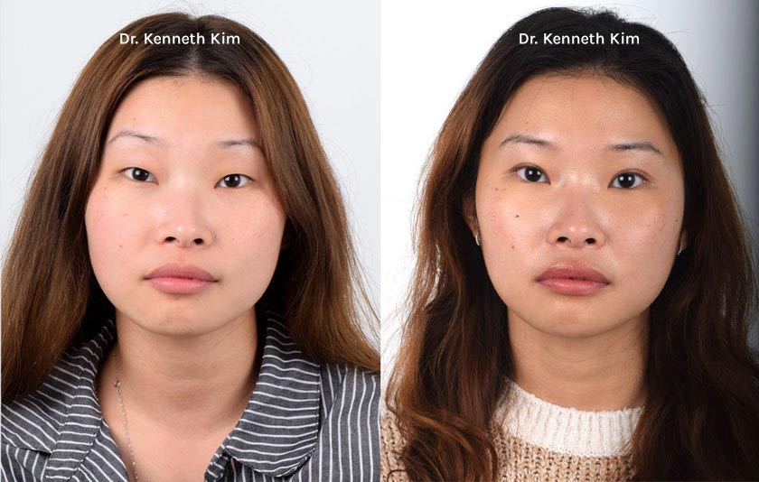 Female Asian patient in her 20s received awake Asian blepharoplasty (double eyelid surgery). The subtle double eyelid folds resulted in softer, brighter, and bigger eyes that enhanced her facial features.