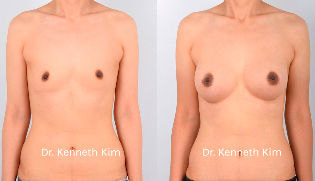 Breast Augmentation Patient-10
