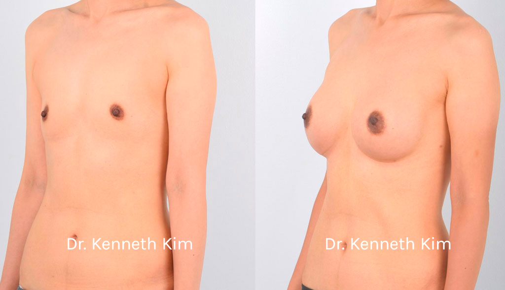 Breast Augmentation Patient-10