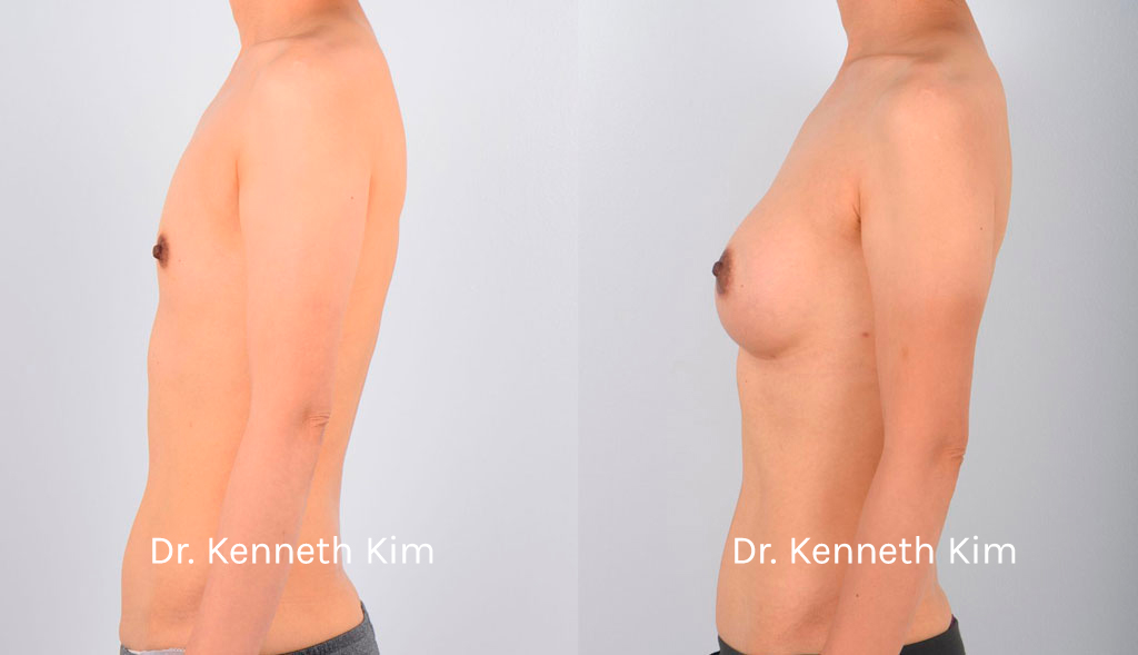 Breast Augmentation Patient-10