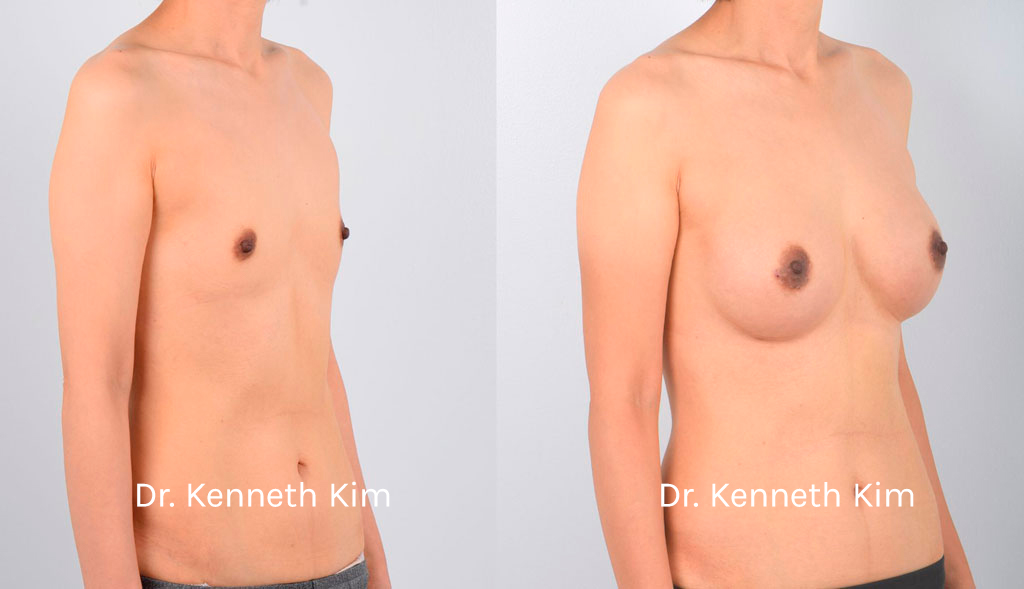 Breast Augmentation Patient-10