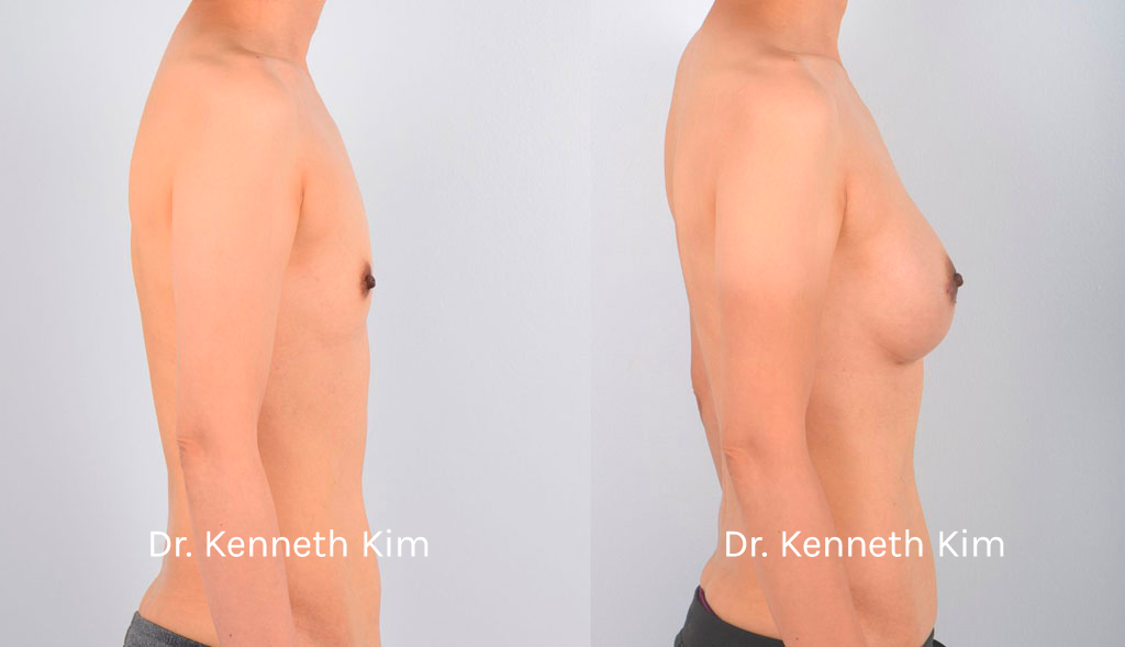 Breast Augmentation Patient-10