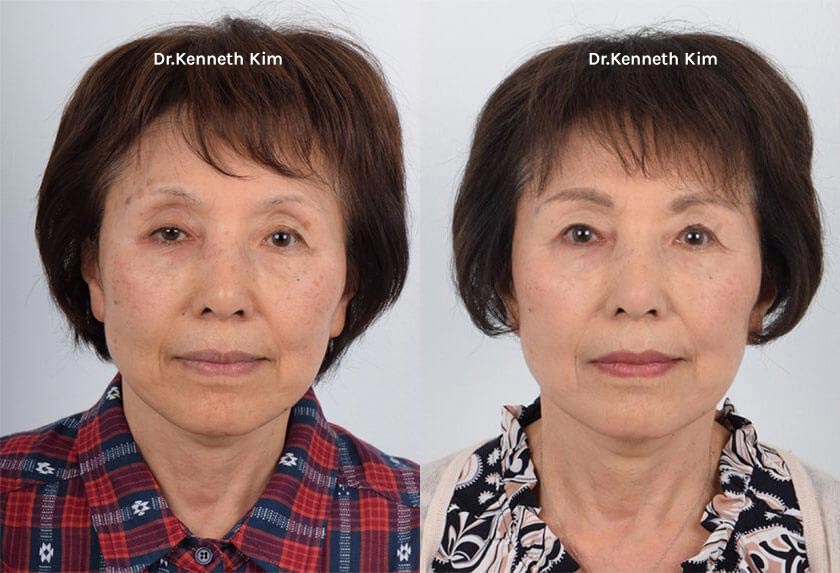 Eyelid Surgery Patient-11