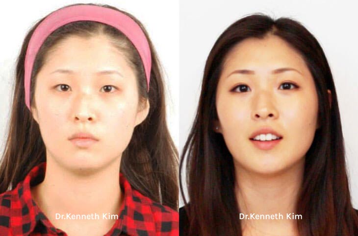 Eyelid Surgery Patient-12