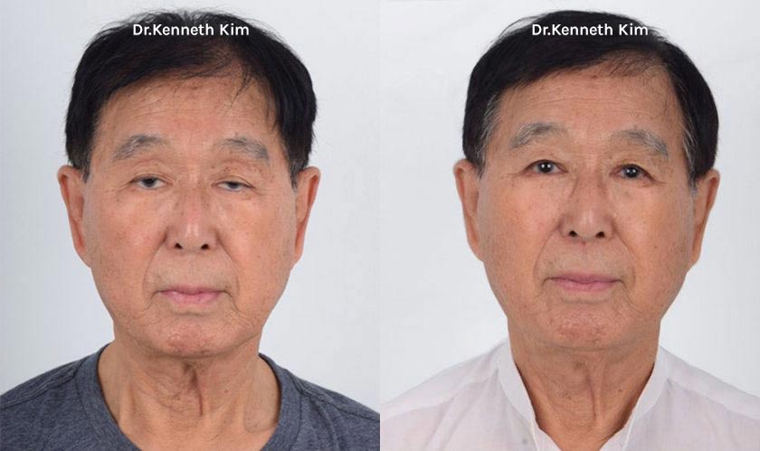 Male Asian patient in his early 70s had asymmetric eyelid ptosis where the condition was more severe in his left eye. Eyelid ptosis describes drooping of the upper eyelid caused by a weak levator muscle. The awake ptosis correction surgery strengthened the weak eye elevating muscles and transformed his eyes from appearing fatigued to well-rested and energized.