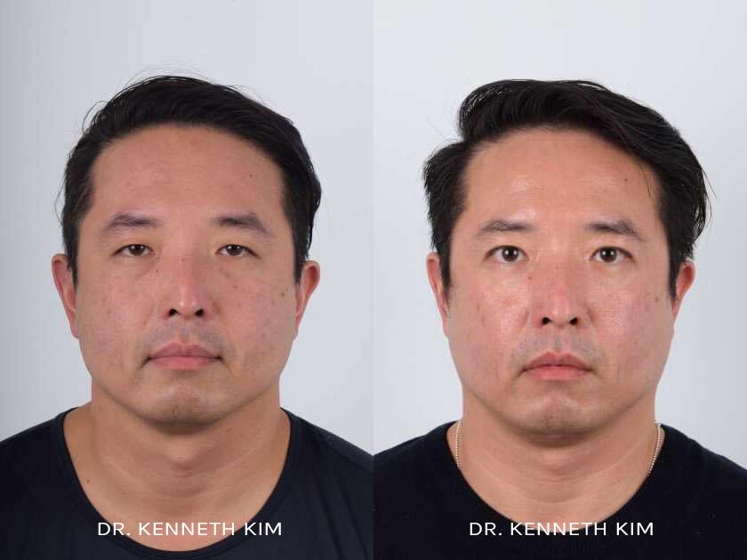 Eyelid Surgery Patient-2