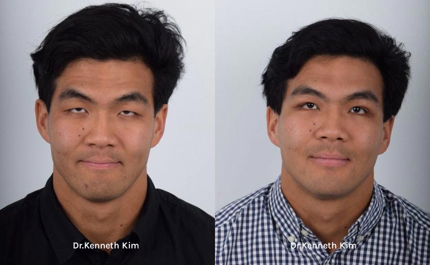 Eyelid Surgery Patient-30