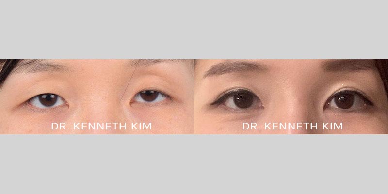 Eyelid Surgery Patient-32