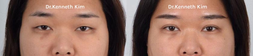 Eyelid Surgery Patient-39