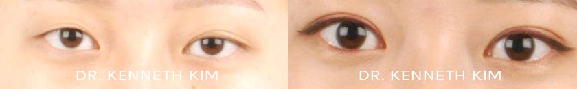 Eyelid Surgery Patient-41