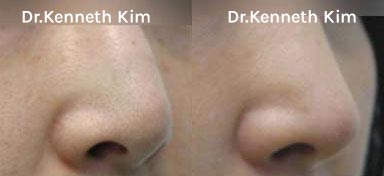 Nose Surgery Patient-4